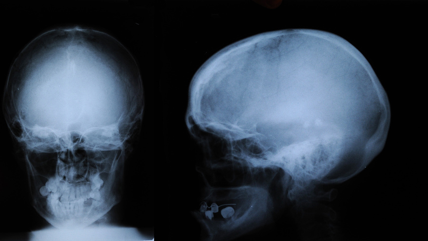 Сотрясение кости. Кости черепа рентген норма. Рентген черепа сотрясение мозга. Рентген черепа сотрясение. Рентгенография черепа (краниография.
